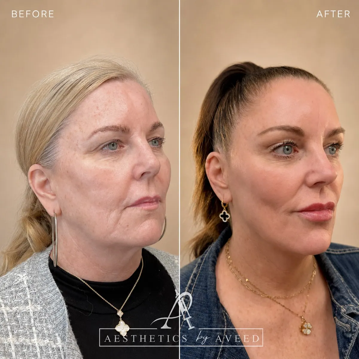 Full-face balancing · Collagen-first approach