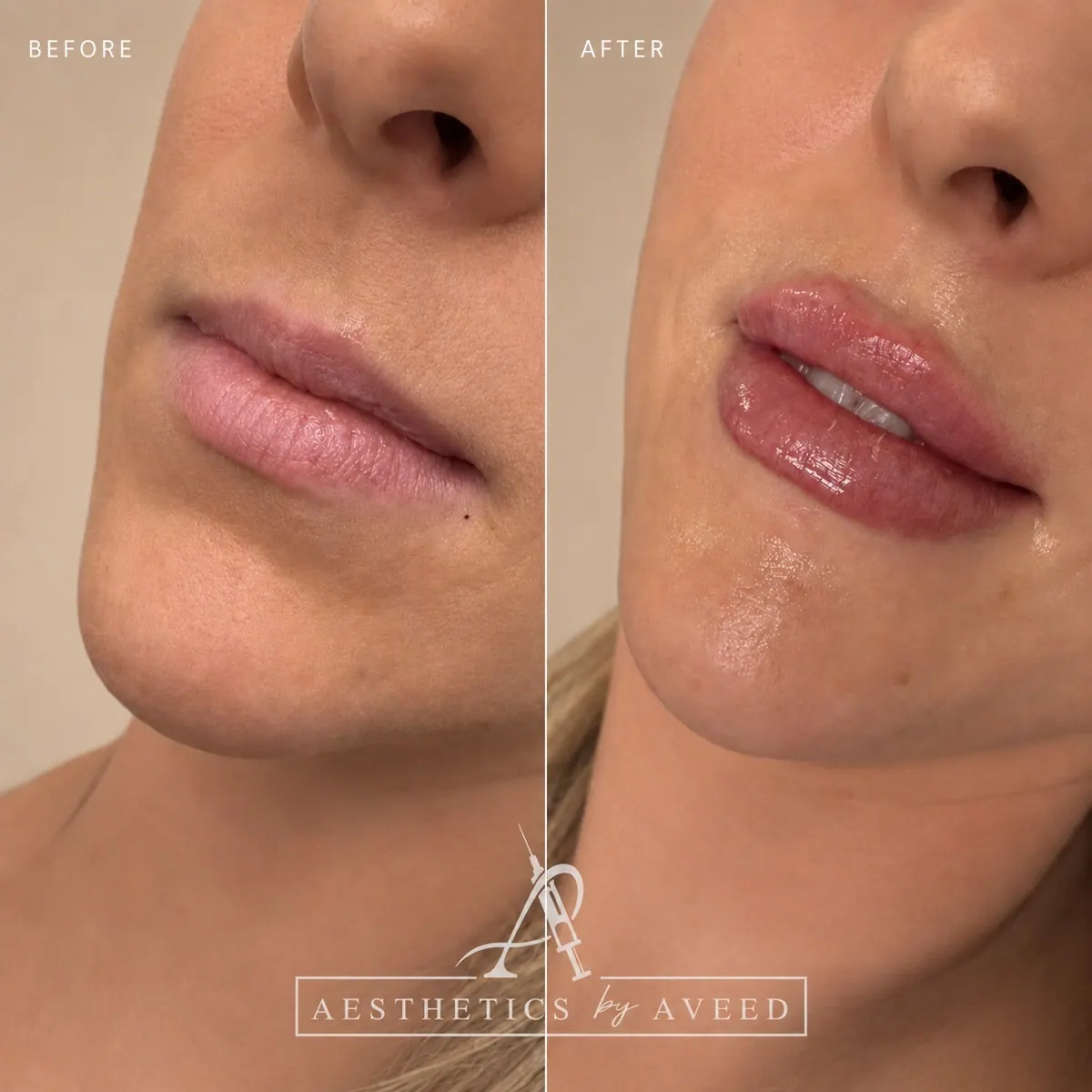 Lip refinement · Soft, balanced shaping