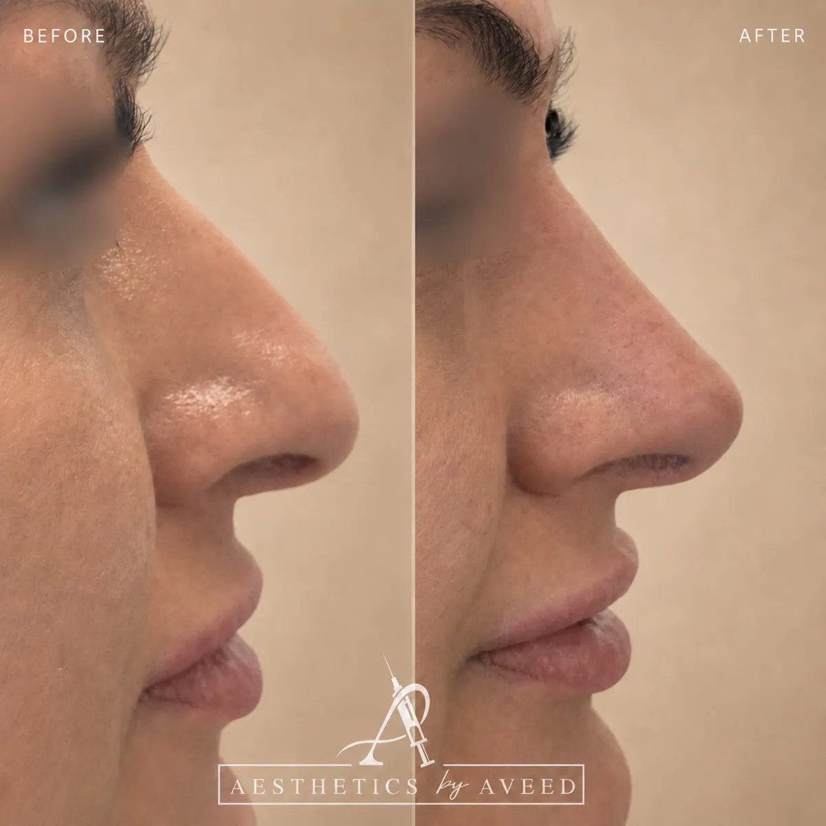 Nonsurgical nose job · Refined profile balancing